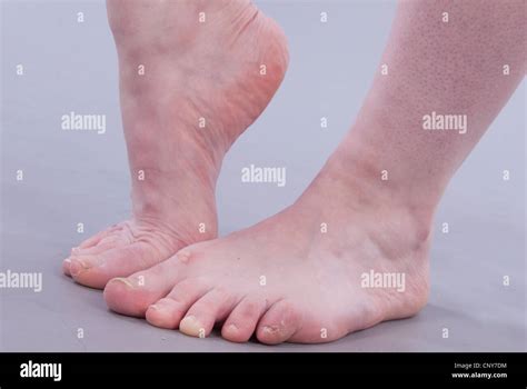 ugly feet pics|Ugly Feet Stock Photos, Images & Pictures